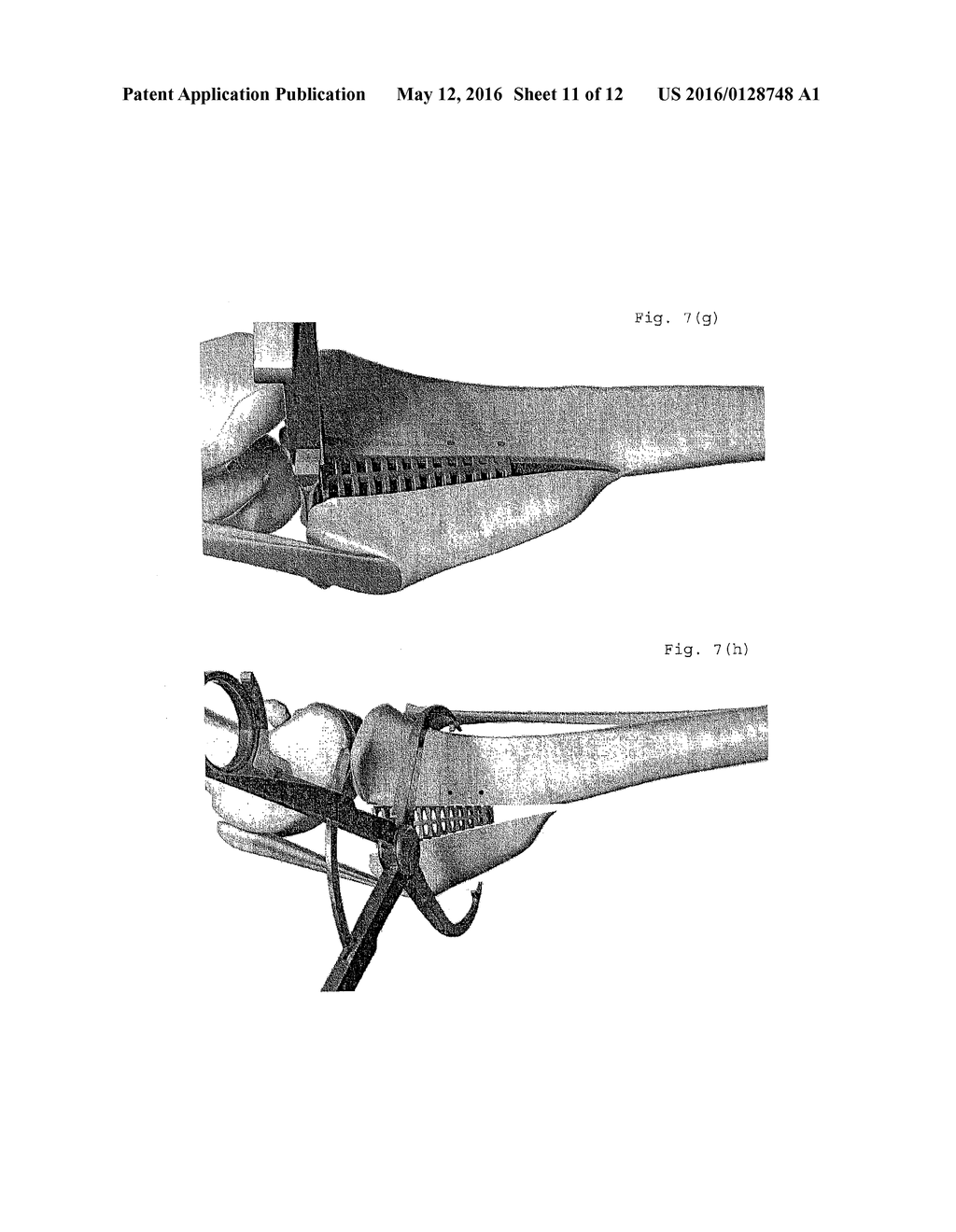 TIBIAL TUBEROSITY ADVANCEMENT CAGE FOR ACL INJURIES - diagram, schematic, and image 12