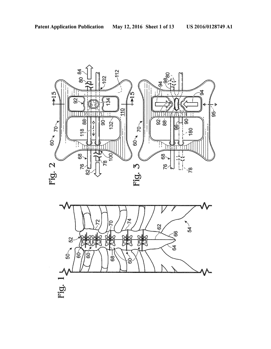 SYSTEM FOR BINDING BONE - diagram, schematic, and image 02