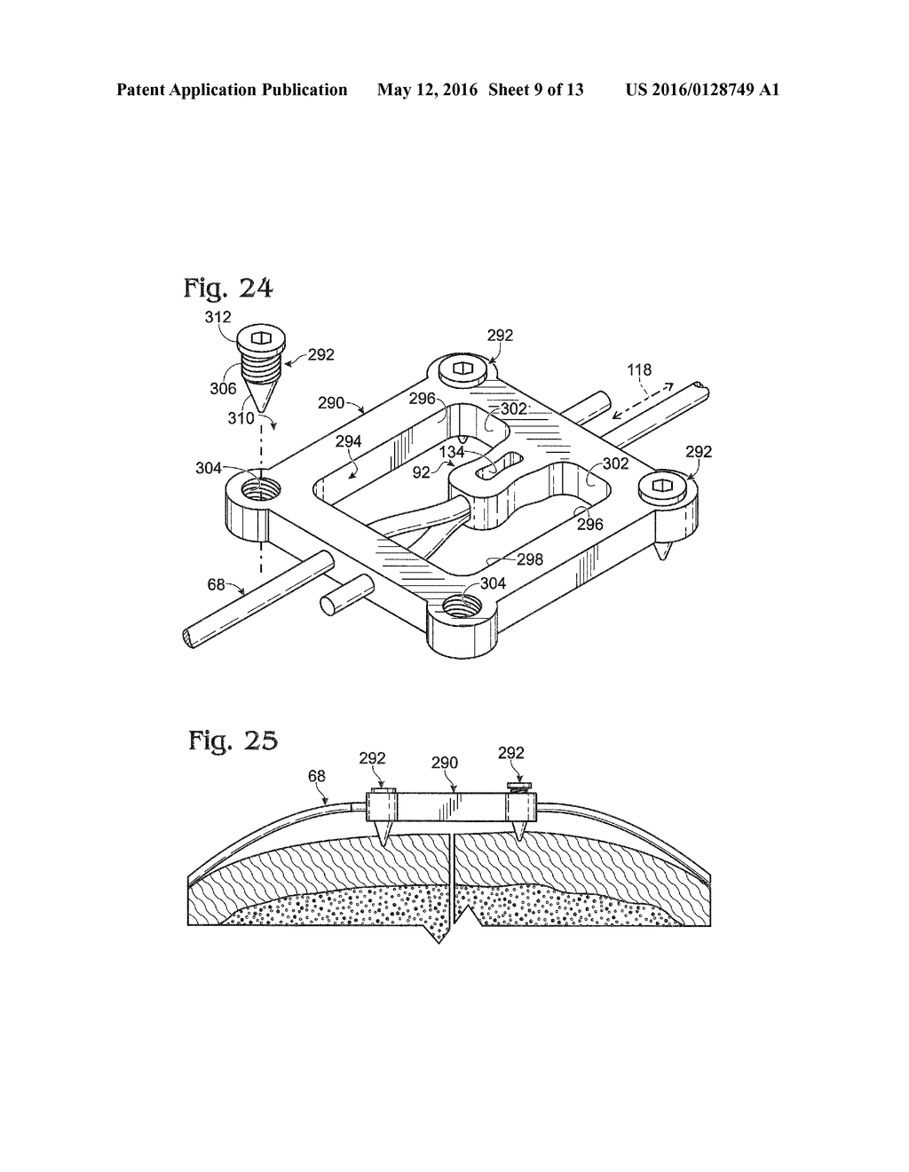 SYSTEM FOR BINDING BONE - diagram, schematic, and image 10