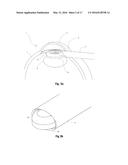 OPHTHALMIC SURGICAL DEVICE FOR CAPSULOTOMY diagram and image