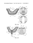 GUIDED SINUS LIFT diagram and image