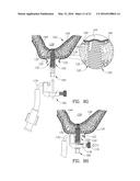 GUIDED SINUS LIFT diagram and image