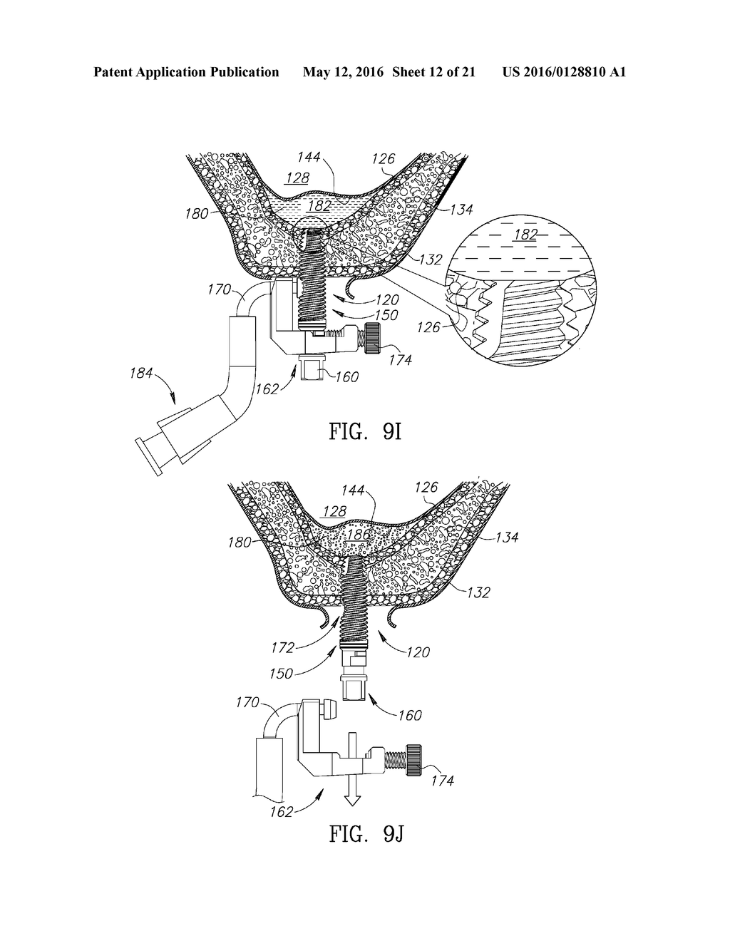 GUIDED SINUS LIFT - diagram, schematic, and image 13