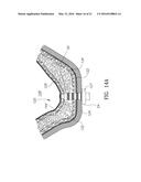 GUIDED SINUS LIFT diagram and image