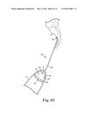 METHOD OF TREATING PROLAPSE OF A VAGINA BY PROVIDING A REINFORCING IMPLANT     INSIDE OF THE VAGINA diagram and image