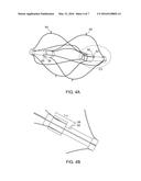 DOUBLE CONICAL IVC FILTER diagram and image