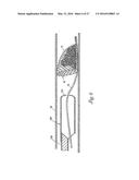 HOLDING ZONE FOR INTRAVASCULAR MEDICAL DEVICE diagram and image