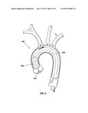 THROMBOEMBOLIC PROTECTION DEVICE diagram and image