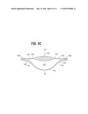 ACCOMMODATING INTRAOCULAR LENS diagram and image