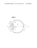 ACCOMMODATING INTRAOCULAR LENS diagram and image