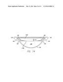 ACCOMMODATING INTRAOCULAR LENS diagram and image