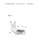 SCAFFOLD IMPLANT SYSTEM diagram and image