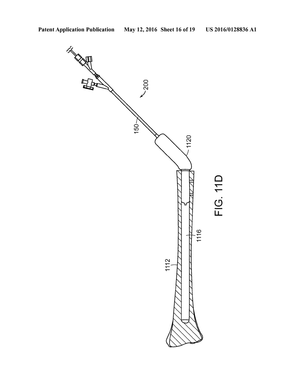 Systems and Methods for Joint Stabilization - diagram, schematic, and image 17