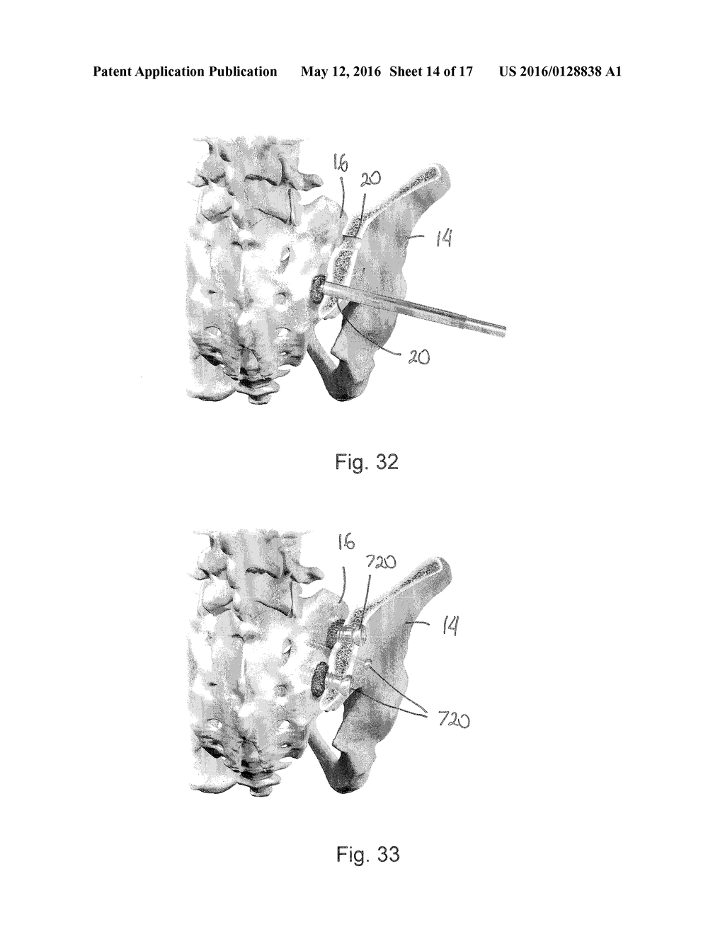 SACROILIAC FUSION SYSTEM - diagram, schematic, and image 15