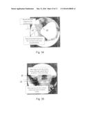 SACROILIAC FUSION SYSTEM diagram and image