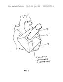 Three dimensional imaging ultrasound with microbubbles to enhance reflow     in ST elevation myocardial infarction diagram and image