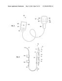 NEUROSTIMULATION TITRATION UTILIZING T-WAVE ALTERNANS diagram and image