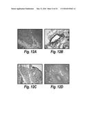 ANTIBODIES AGAINST CD38 FOR TREATMENT OF MULTIPLE MYELOMA diagram and image