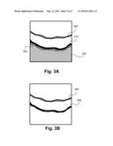 Robust segmentation of retinal pigment epithelium layer diagram and image