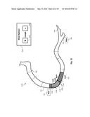 PERCUTANEOUS CORONARY INTERVENTION (PCI) PLANNING INTERFACE AND ASSOCIATED     DEVICES, SYSTEMS, AND METHODS diagram and image