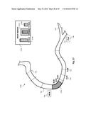 PERCUTANEOUS CORONARY INTERVENTION (PCI) PLANNING INTERFACE AND ASSOCIATED     DEVICES, SYSTEMS, AND METHODS diagram and image