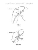 DEVICE AND METHOD FOR SUTURING INTRACARDIAC DEFECTS diagram and image