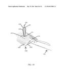 Methods for Passing Multiple Sutures Through Tissue diagram and image