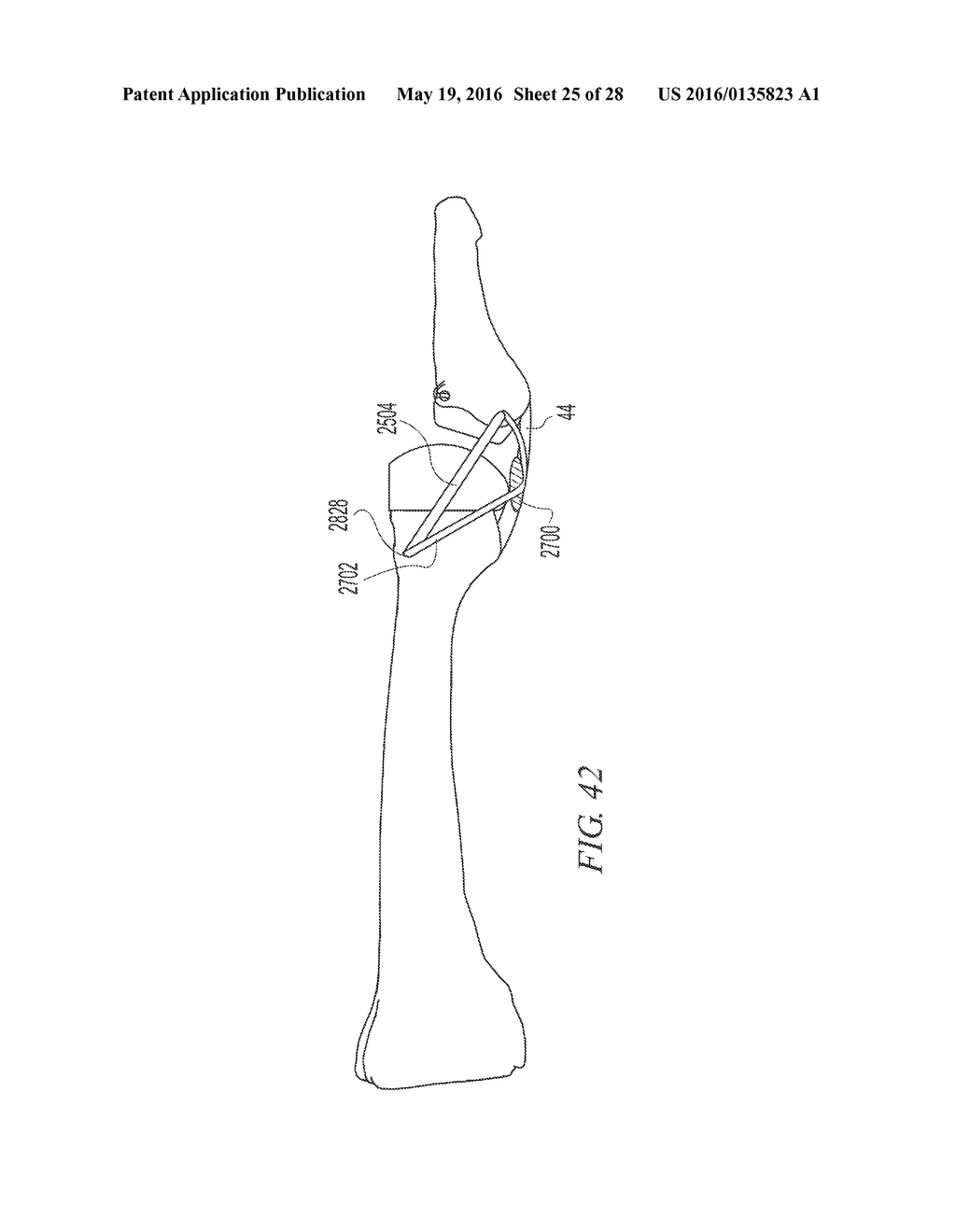 SOFT TISSUE RECONSTRUCTION - diagram, schematic, and image 26