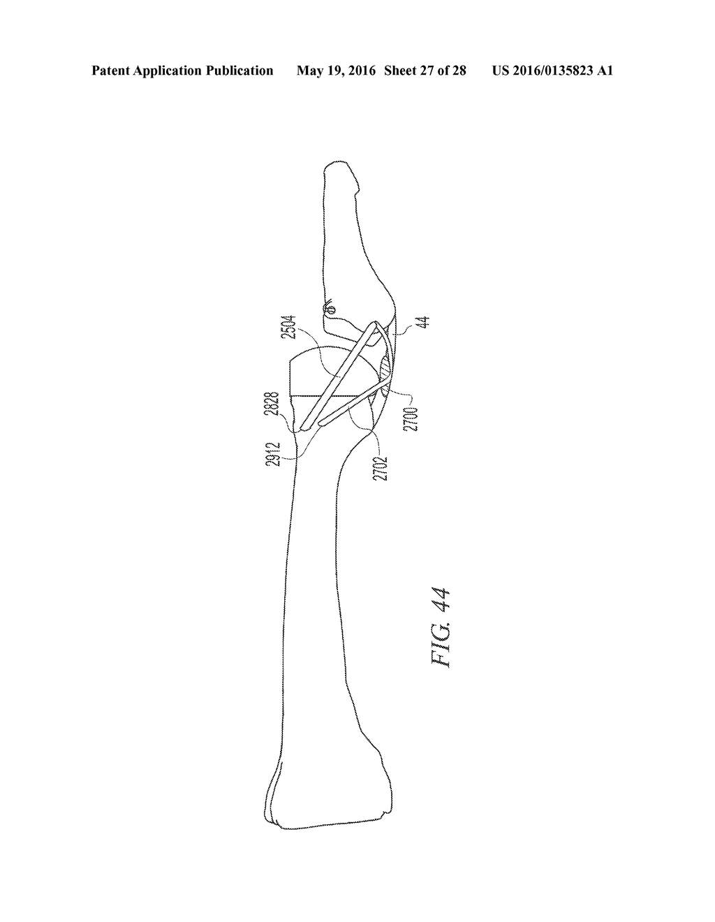 SOFT TISSUE RECONSTRUCTION - diagram, schematic, and image 28