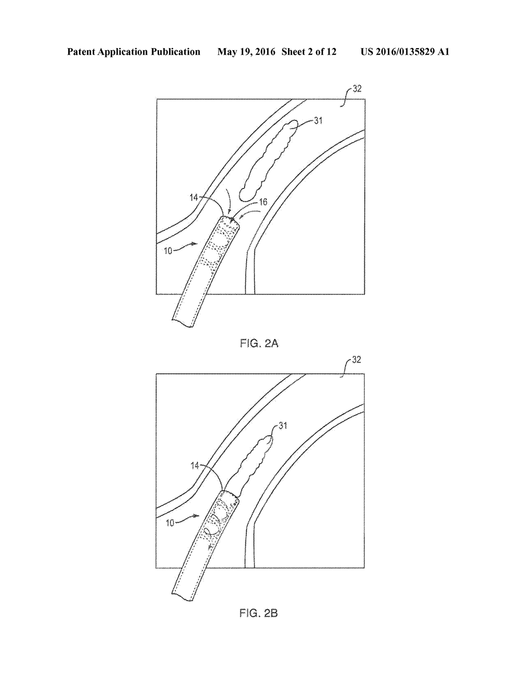 SYSTEMS AND METHODS FOR EN BLOC REMOVAL OF UNDESIRABLE MATERIAL FROM     PASSAGEWAYS - diagram, schematic, and image 03