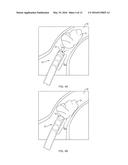 SYSTEMS AND METHODS FOR EN BLOC REMOVAL OF UNDESIRABLE MATERIAL FROM     PASSAGEWAYS diagram and image