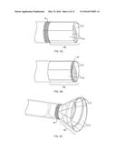 SYSTEMS AND METHODS FOR EN BLOC REMOVAL OF UNDESIRABLE MATERIAL FROM     PASSAGEWAYS diagram and image