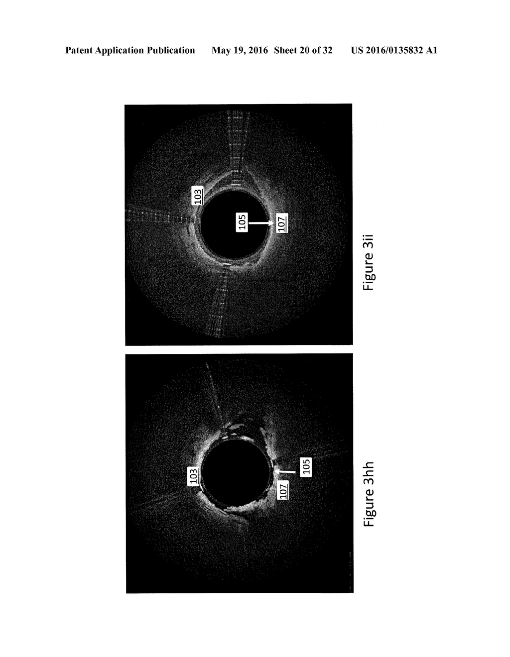 IDENTIFICATION OF ELASTIC LAMINA TO GUIDE INTERVENTIONAL THERAPY - diagram, schematic, and image 21