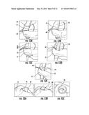 TISSUE ACCESS SITE SYSTEM AND METHOD diagram and image