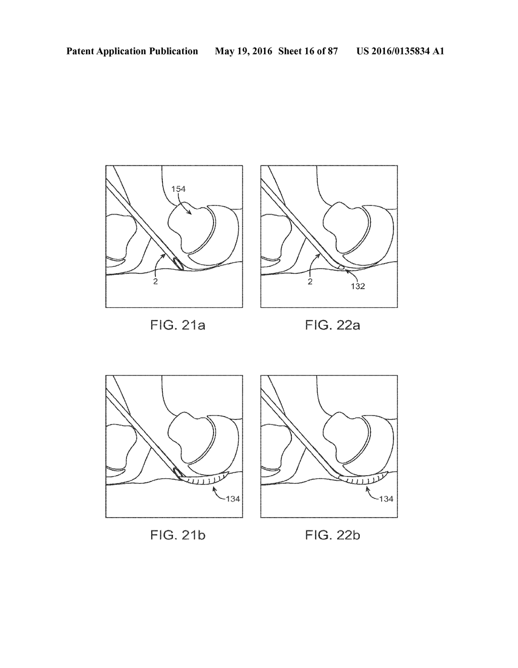 DEVICES AND METHODS FOR TISSUE ACCESS - diagram, schematic, and image 17