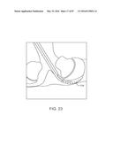 DEVICES AND METHODS FOR TISSUE ACCESS diagram and image