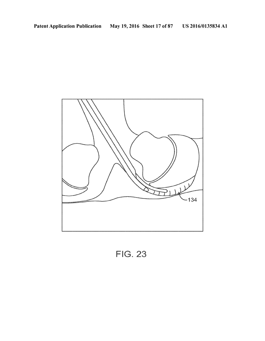 DEVICES AND METHODS FOR TISSUE ACCESS - diagram, schematic, and image 18