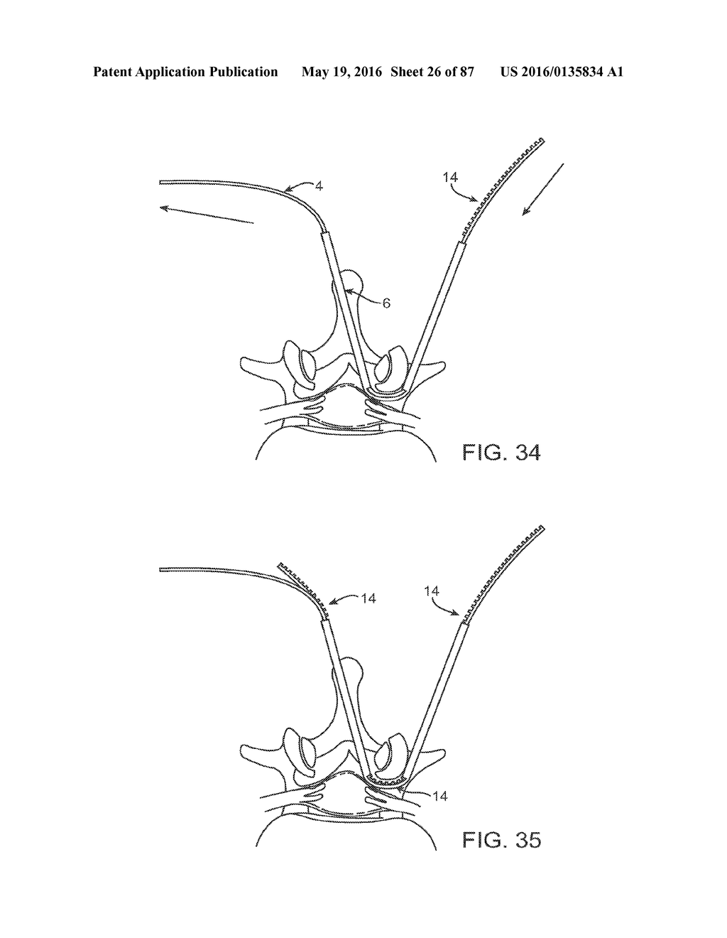 DEVICES AND METHODS FOR TISSUE ACCESS - diagram, schematic, and image 27