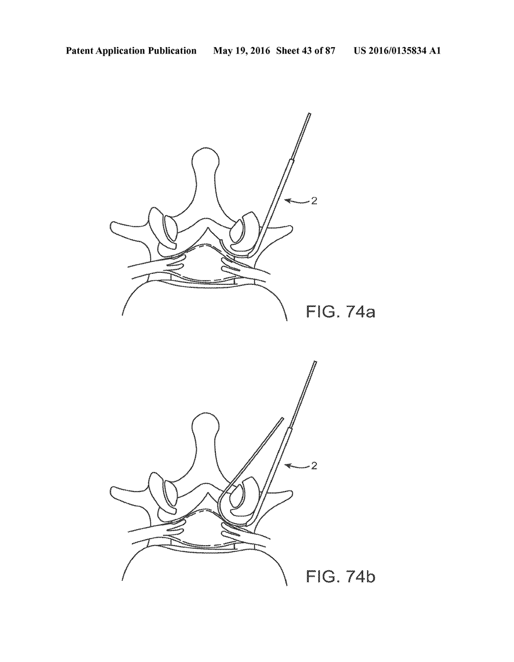 DEVICES AND METHODS FOR TISSUE ACCESS - diagram, schematic, and image 44