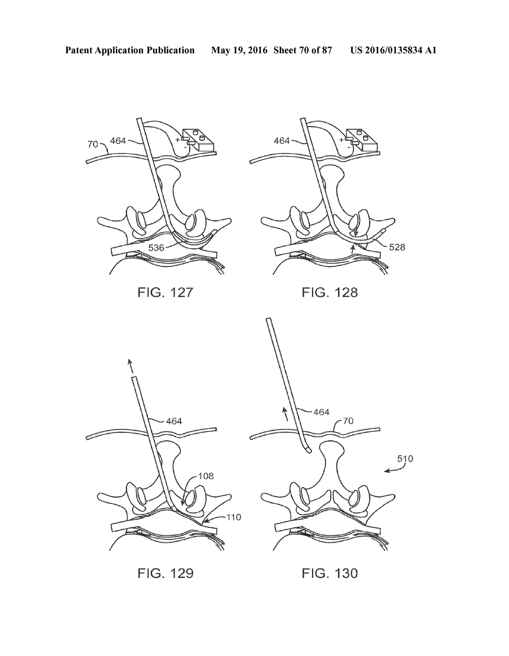 DEVICES AND METHODS FOR TISSUE ACCESS - diagram, schematic, and image 71