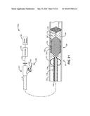 TEMPORARY VASCULAR SCAFFOLD AND SCORING DEVICE diagram and image