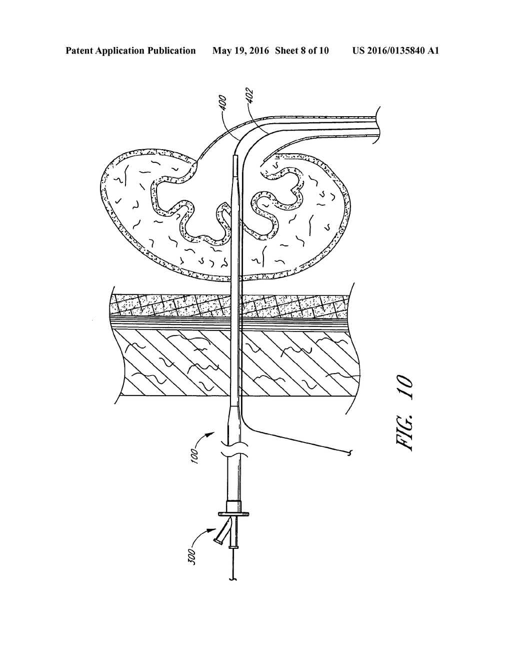 Expandable Percutaneous Sheath - diagram, schematic, and image 09