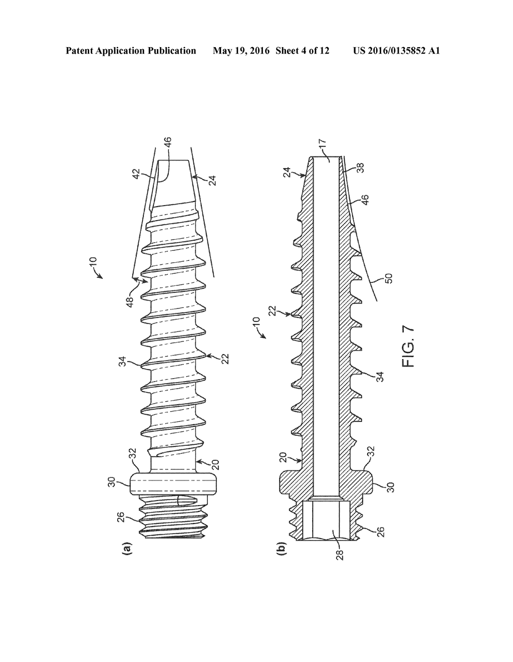 Facet screw and method for spinal stabilization - diagram, schematic, and image 05