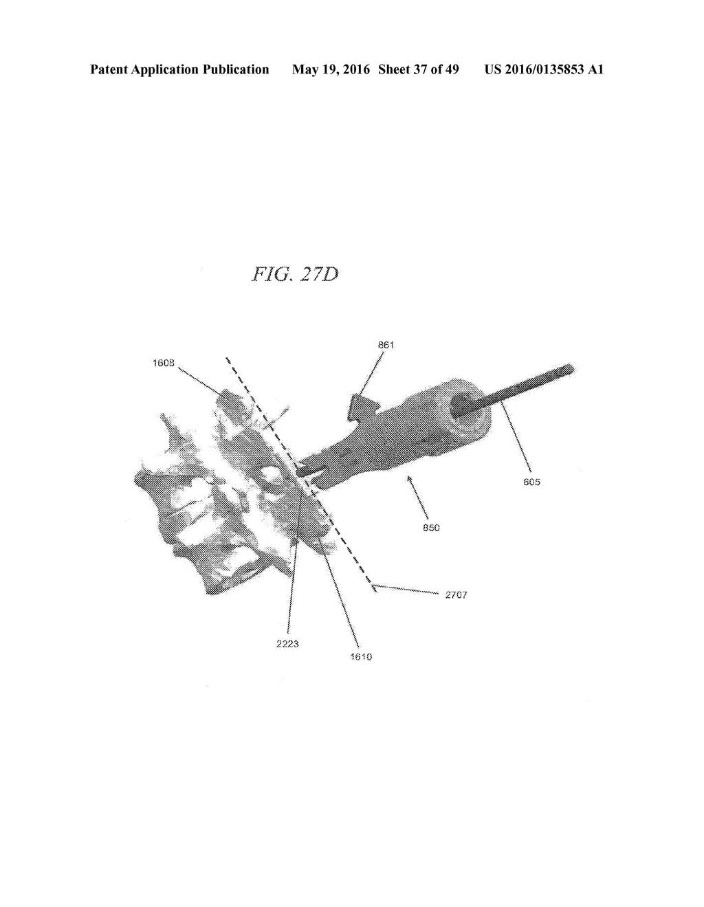 MINIMALLY INVASIVE TOOLING FOR DELIVERY OF INTERSPINOUS SPACER - diagram, schematic, and image 38