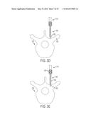 BONE ANCHORS AND SURGICAL INSTRUMENTS WITH INTEGRATED GUIDE TIPS diagram and image