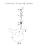 BONE ANCHORS AND SURGICAL INSTRUMENTS WITH INTEGRATED GUIDE TIPS diagram and image