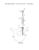 BONE ANCHORS AND SURGICAL INSTRUMENTS WITH INTEGRATED GUIDE TIPS diagram and image