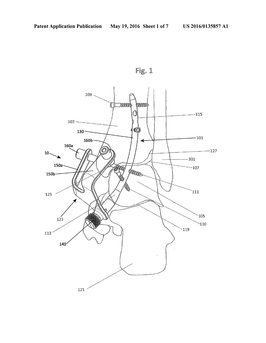 CURVED TIBIOTALAR FUSION NAIL AND METHOD OF USE - diagram, schematic, and image 02