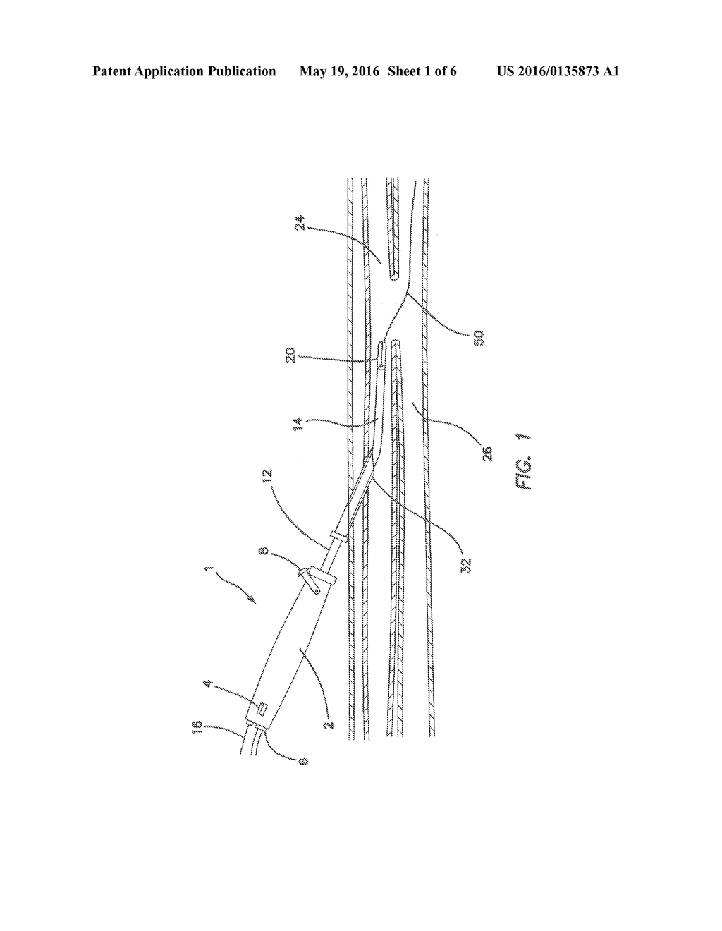 SYSTEMS AND METHODS FOR PERCUTANEOUS INTRAVASCULAR ACCESS FOR     ARTERIOVENOUS FISTULA - diagram, schematic, and image 02