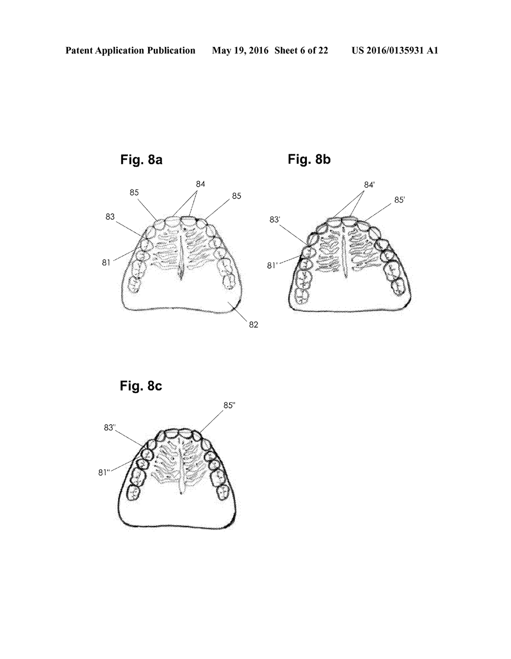 APPARATUS AND METHODS OF MAKING DENTURE DEVICES - diagram, schematic, and image 07